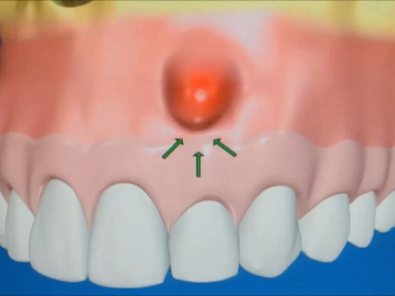 prikaz fistule na desnima