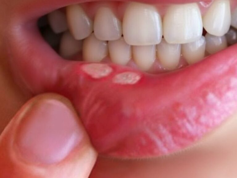 devojka pokazuje aftu na usni