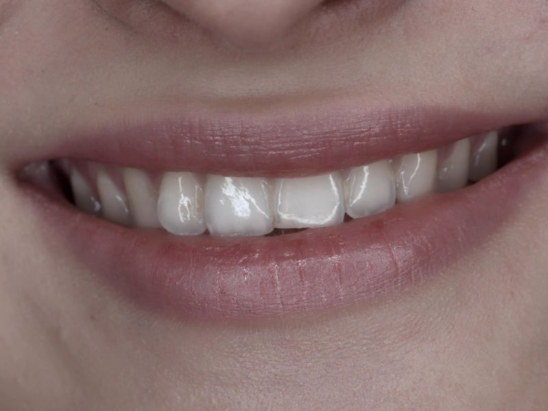 prikaz prelepog belog osmeha