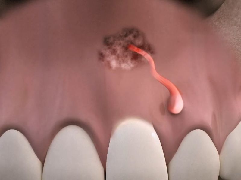 nastanak fistule na zubima