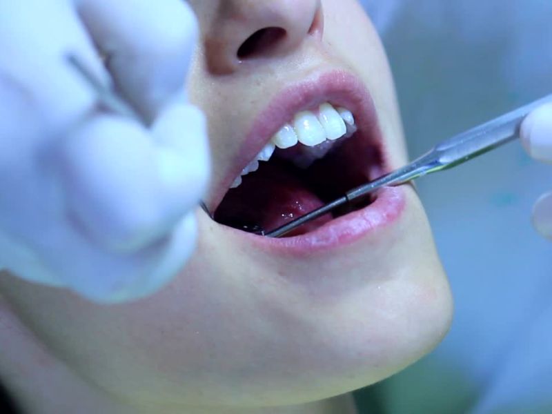 devojka kod zubara uklanja kamenac